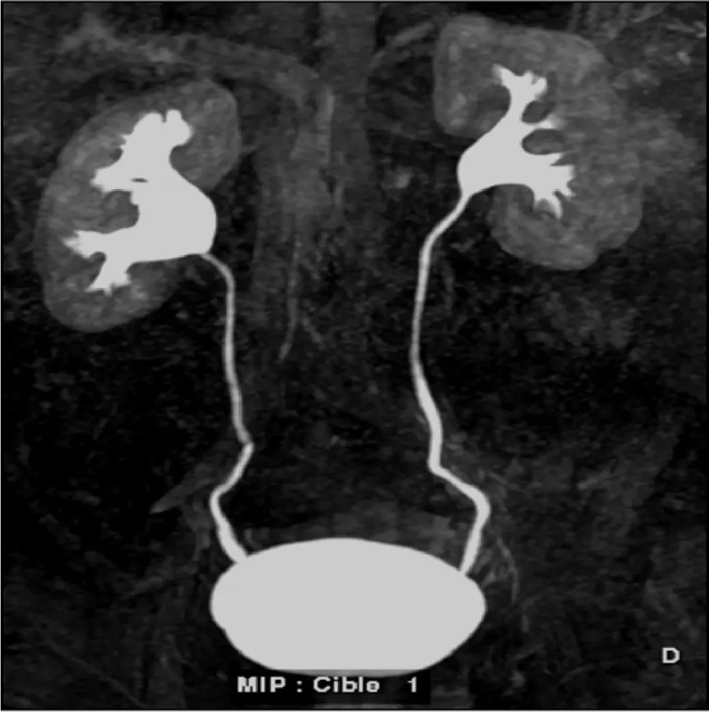 Parenchima -Imaging chronic kidney disease - kidney MRI